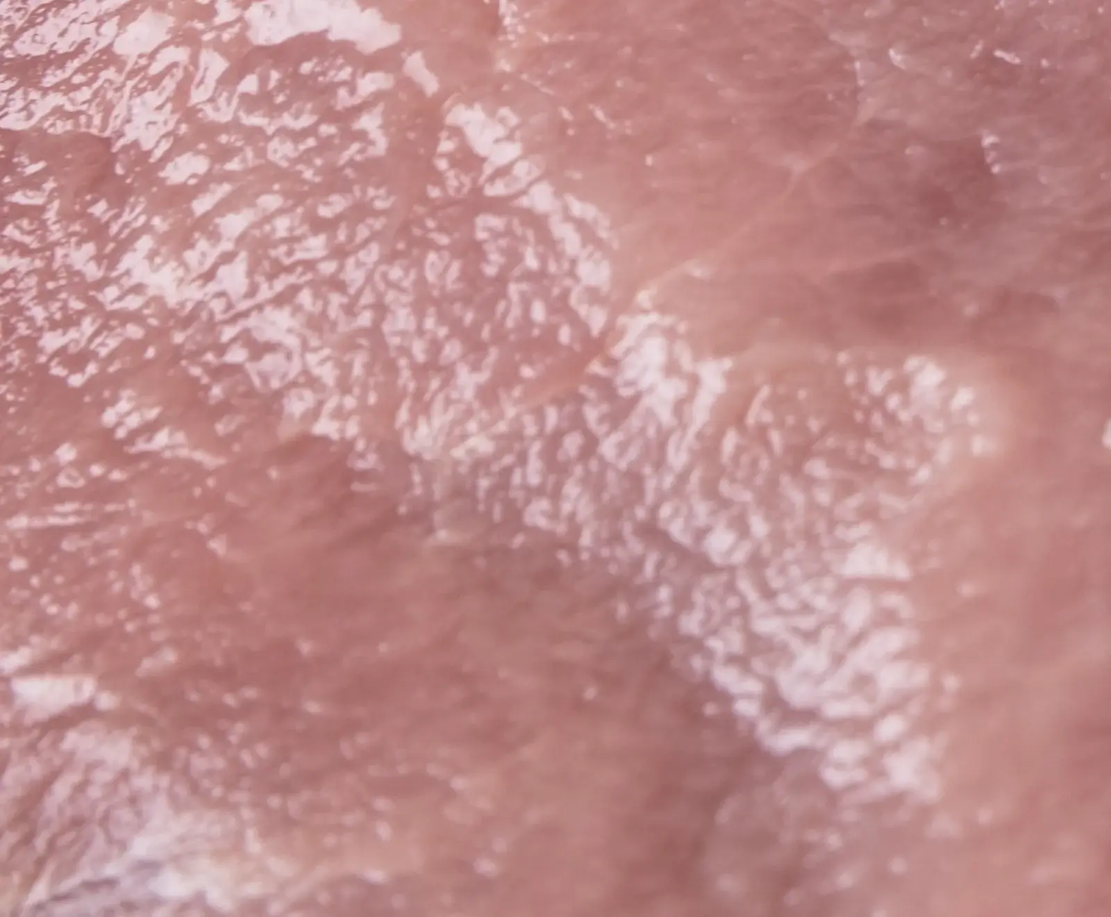 Nahaufnahme einer menschlichen Zunge, die eine raue, unebene Oberfläche mit weißen Flecken aufweist